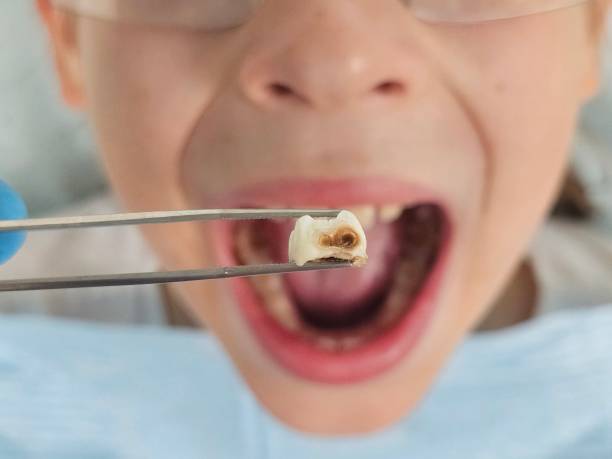 Best Emergency Tooth Extraction in Stock Island, FL